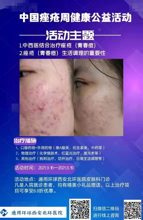 皮肤科|中国痤疮周健康公益活动